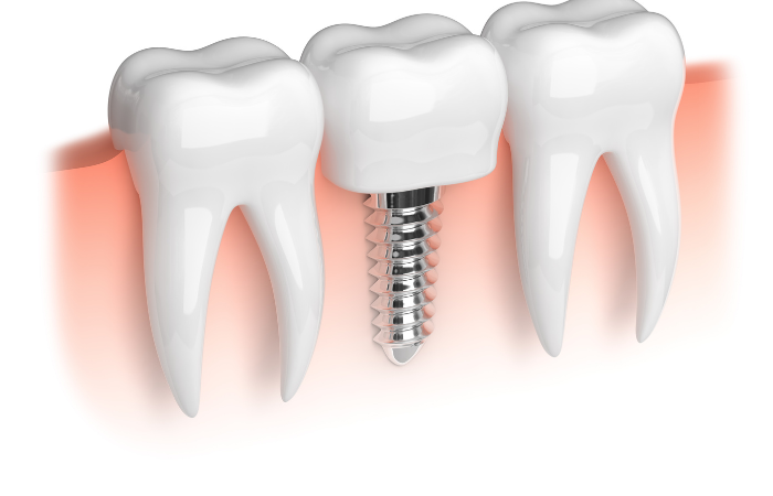 dental implant permanent solution